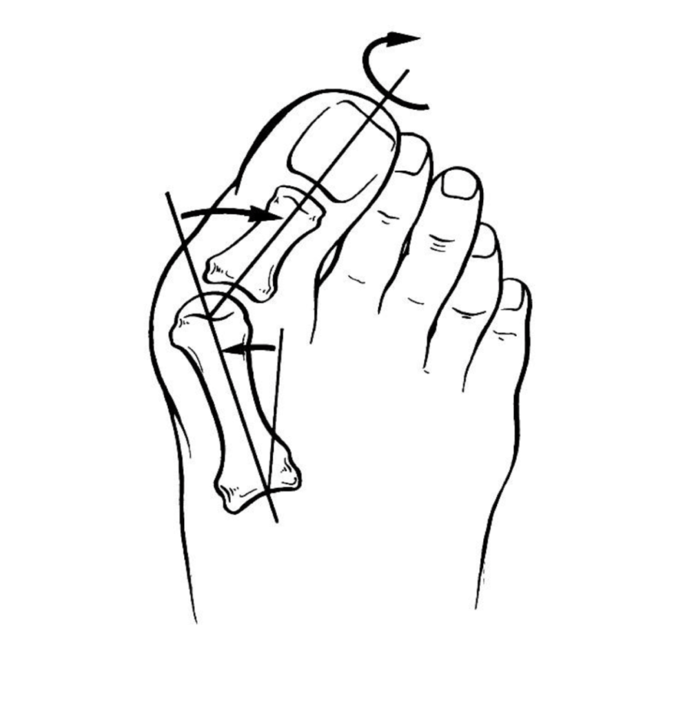 Hallux Valgus Beno t Jouan Podologue Paris 13 Semelles 