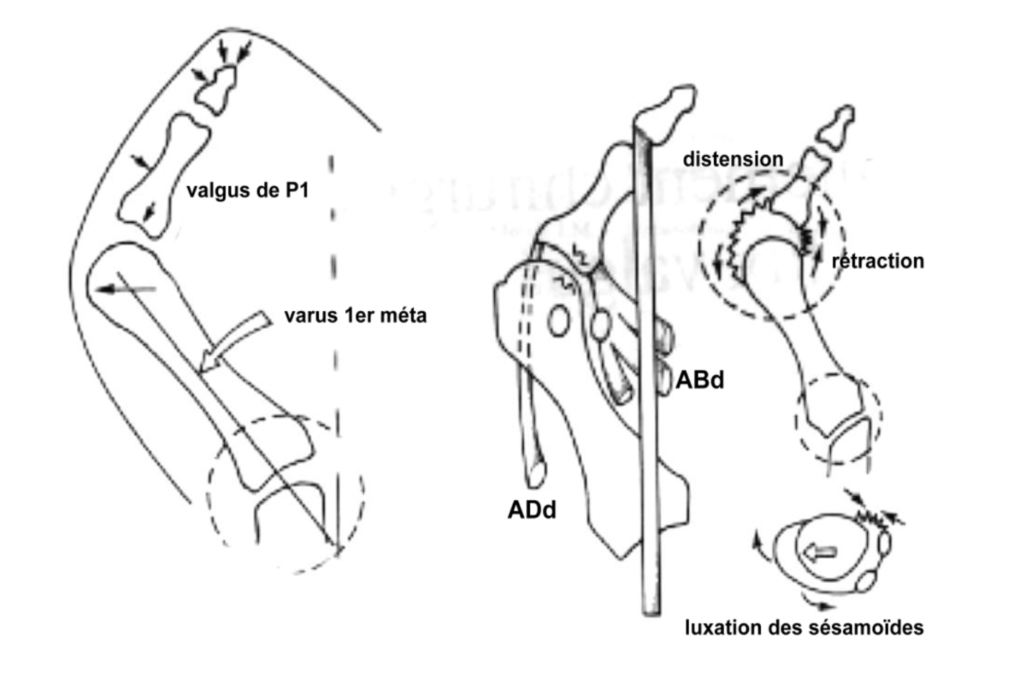 Hallux Valgus Beno t Jouan Podologue Paris 13 Semelles 